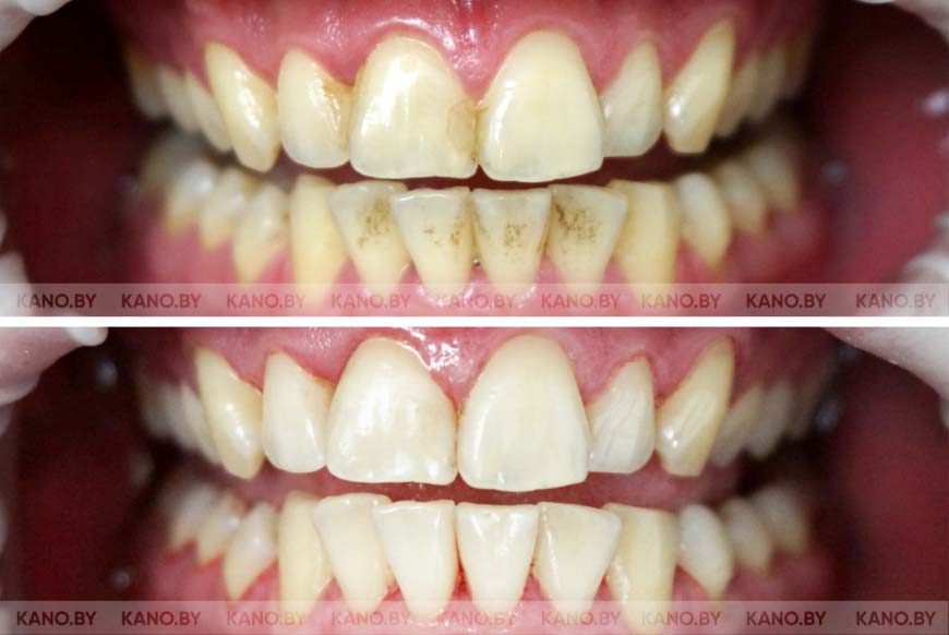 Зубной камень – фото, причины, удаление камней на зубах | Гигиена и Отбеливание
